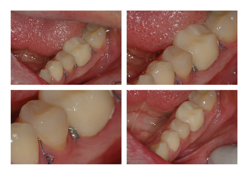 Osseous Recontouring MB pg 2.jpg